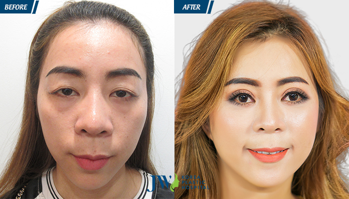 Phẫu thuật thẩm mỹ mắt kiêng ăn gì - hình 4