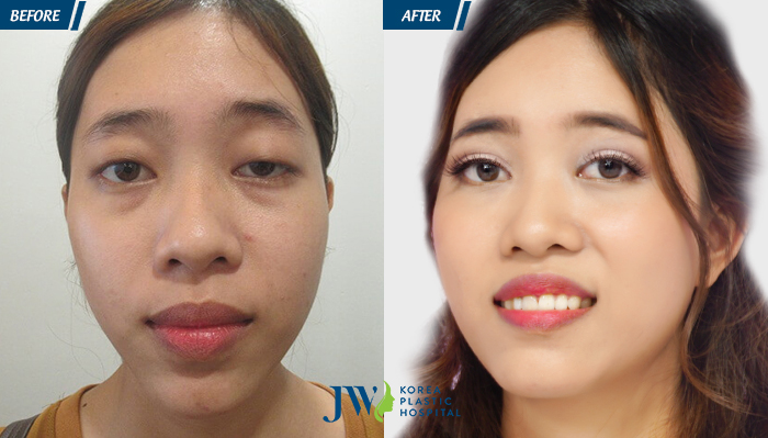 Tại sao phải phẫu thuật thẩm mỹ mắt sụp mí - hình 5