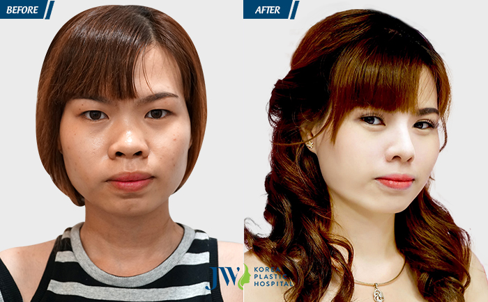 Phẫu thuật nâng mũi S Line bao nhiêu tiền - hình 4