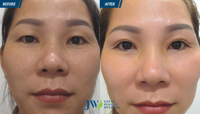 Thẩm mỹ mắt to ở đâu đẹp và uy tín nhất hiện nay - hình 4