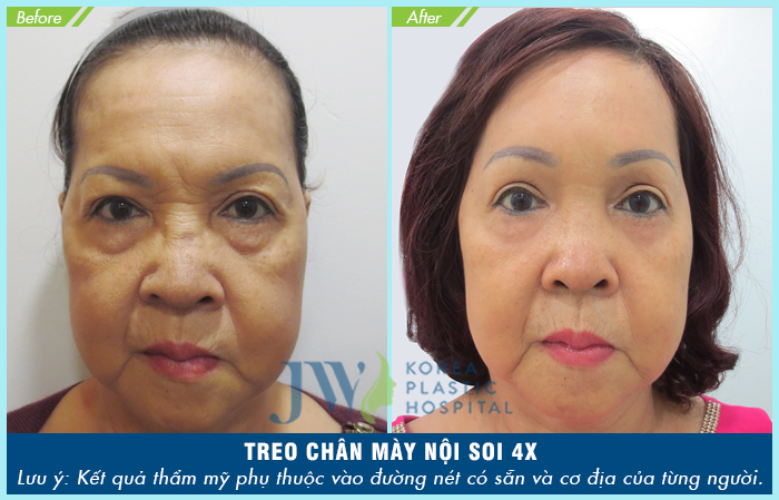 Thẩm mỹ treo chân mày là gì và có đau không- hình 4