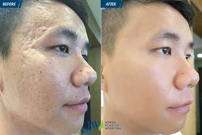 trị mụn, trị mụn trứng cá trị mụn, trị mụn trứng cá