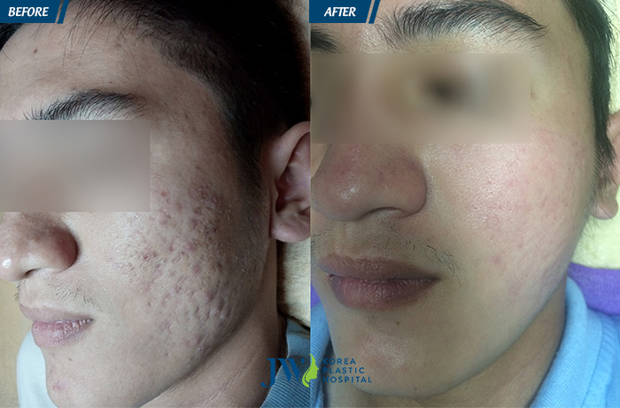 trị mụn, trị mụn trứng cá trị mụn, trị mụn trứng cá