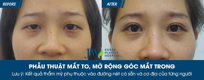 Phẫu thuật mắt to ở đâu tốt nhất - hình 6
