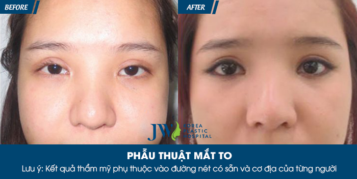 Phẫu thuật mắt to ở đâu tốt nhất - hình 5
