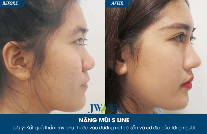 nang-mui-han-quoc-bao-nhieu-tien-3-dieu-can-biet-2