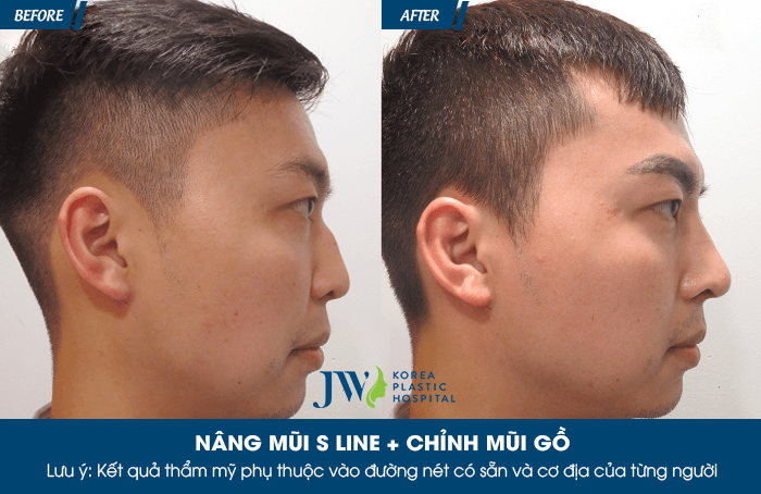 nang-mui-han-quoc-bao-nhieu-tien-3-dieu-can-biet-3
