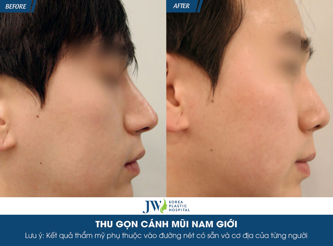 hoi-dap-nhung-dieu-dang-quan-tam-ve-thu-gon-canh-mui-cho-nam-gioi-7