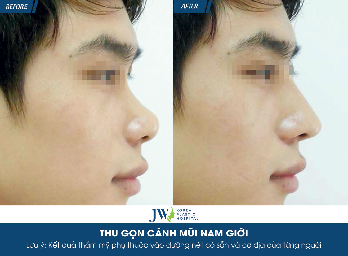 hoi-dap-nhung-dieu-dang-quan-tam-ve-thu-gon-canh-mui-cho-nam-gioi-8