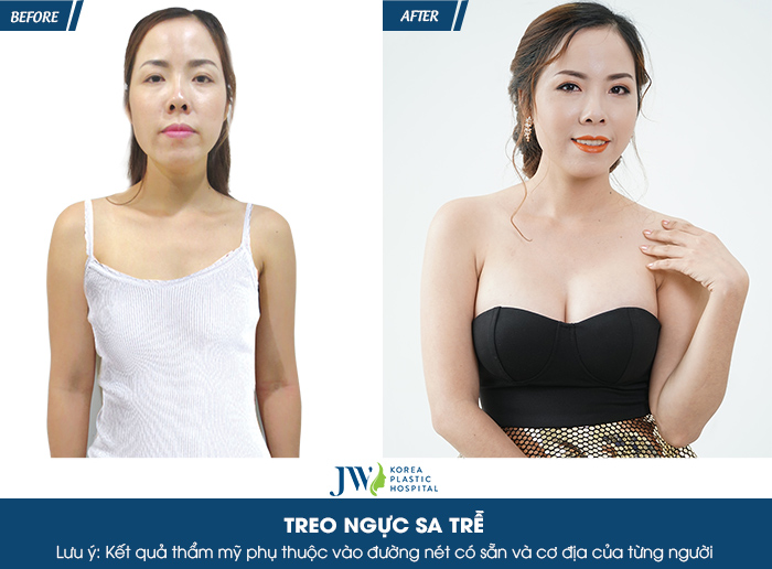 Treo sa trễ giá bao nhiêu? Thông tin vàng trong làng thẩm mỹ_3