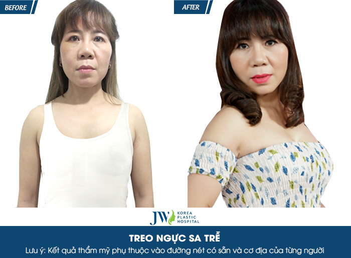Treo sa trễ giá bao nhiêu? Thông tin vàng trong làng thẩm mỹ_4