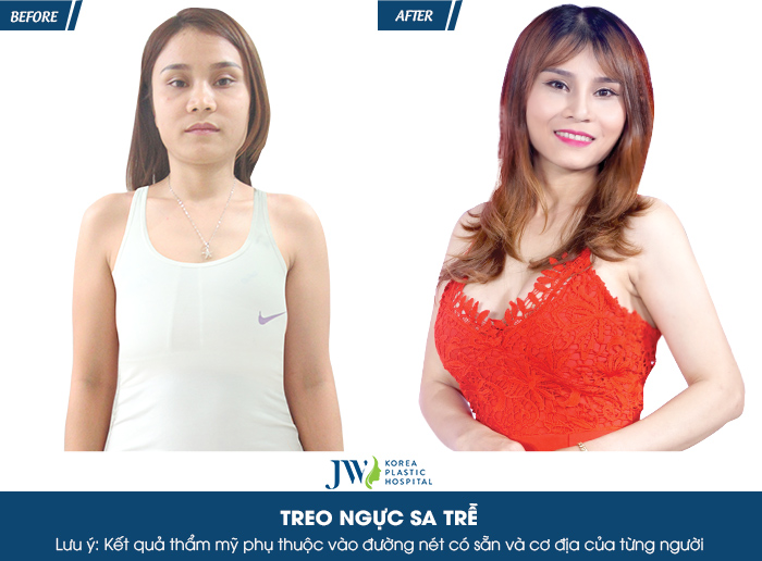 Treo sa trễ giá bao nhiêu? Thông tin vàng trong làng thẩm mỹ_5