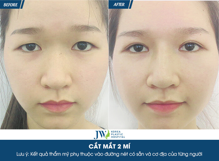 review-cat-mi-mat-nhung-dau-hieu-cho-thay-ban-can-chinh-sua-mat-ngay-5