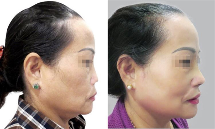 TS.BS Nguyễn Phan Tú Dung – Người cứu chữa thành công hàng nghìn ca mũi hỏng- hình 6
