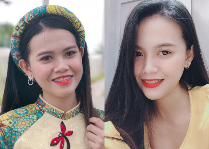 truoc-va-sau-phau-thuat-tham-my-5