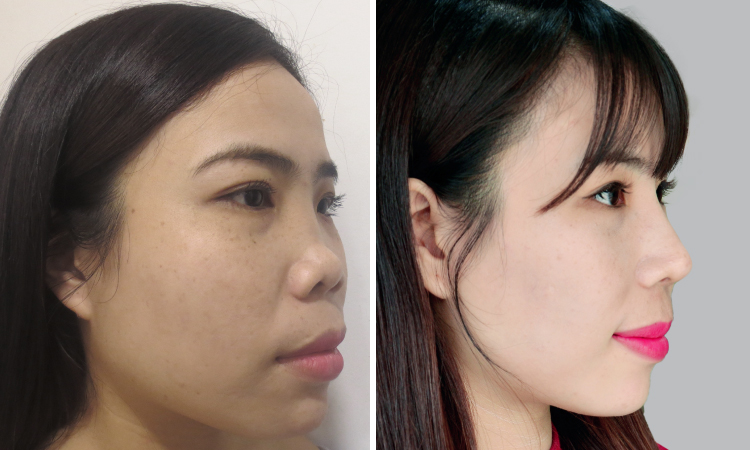 TS.BS Nguyễn Phan Tú Dung giảng dạy chuyên đề mũi cho hơn 500 bác sĩ tại Bệnh viện Tai Mũi Họng TP.HCM -4