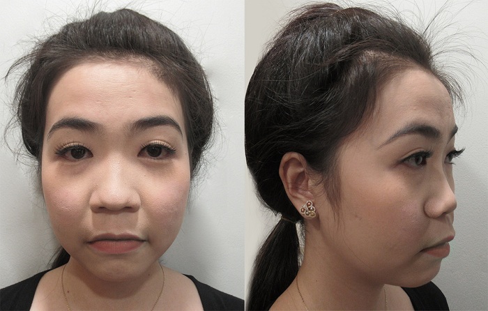 Diễn viên Hà Trí Quang “phát cuồng” với nhan sắc của “Người đẹp Tây Đô” sau nâng mũi - 2