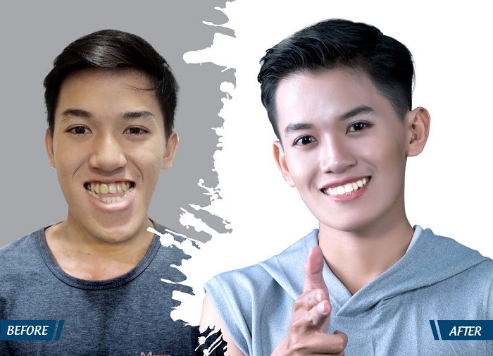 Hàng loạt bạn trẻ được “cứu đời” nhờ phẫu thuật thẩm mỹ - hình 3