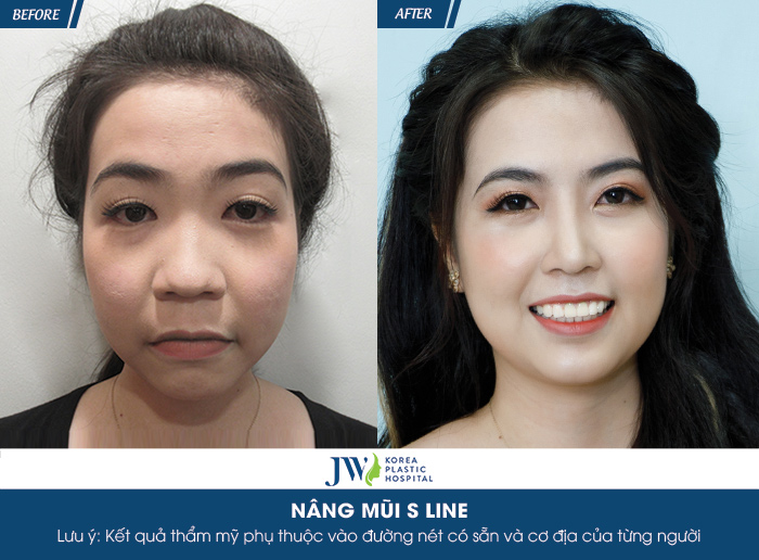 Diễn viên Hà Trí Quang “phát cuồng” với nhan sắc của “Người đẹp Tây Đô” sau nâng mũi - 6