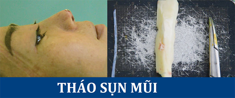 phẫu thuật tháo sống mũi