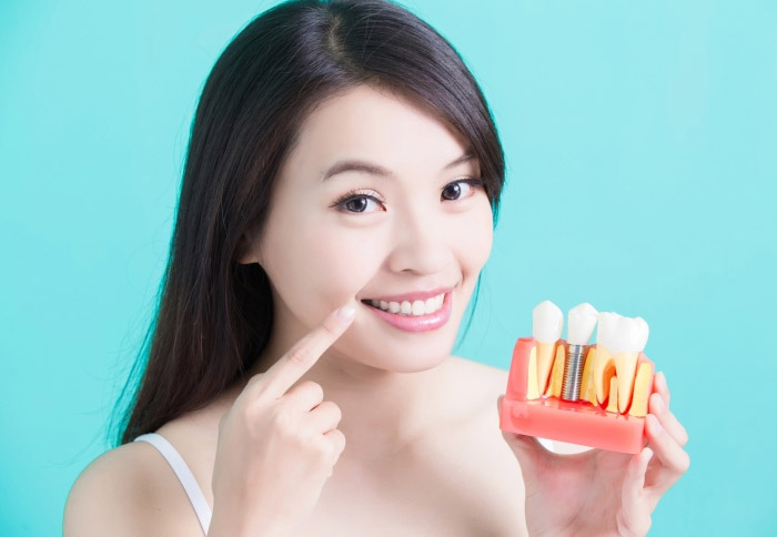 Bảng giá cấy ghép Implant