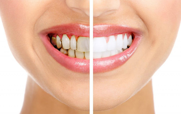 Bảng giá Tẩy Trắng Răng - Bệnh viện thẩm mỹ JW Hàn Quốc Bảng giá Tẩy Trắng Răng chất lượng