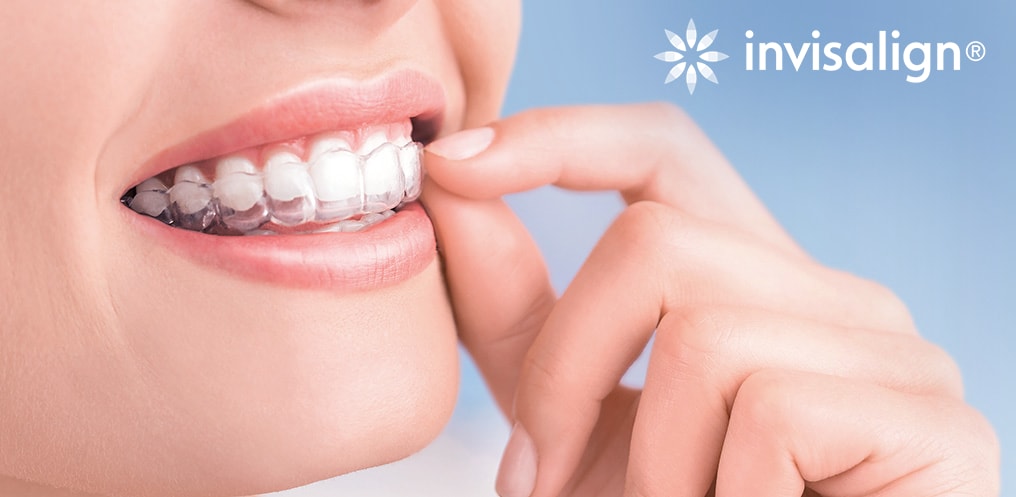 Niềng răng Invisalige khay trong suốt
