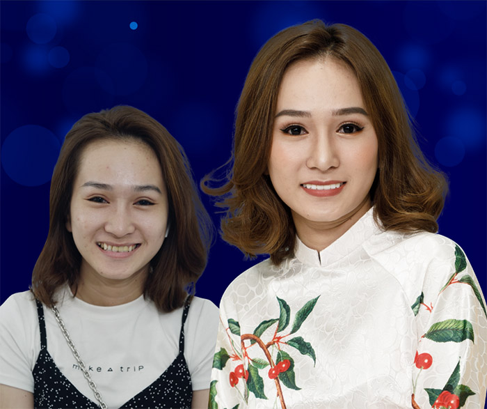 xinh hơn sau khi làm răng sứ