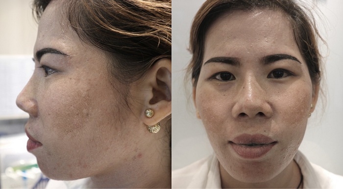 Người phụ nữ An Giang được “tái sinh” sau liệu trình trị nám do dùng kem trộn - hình 2