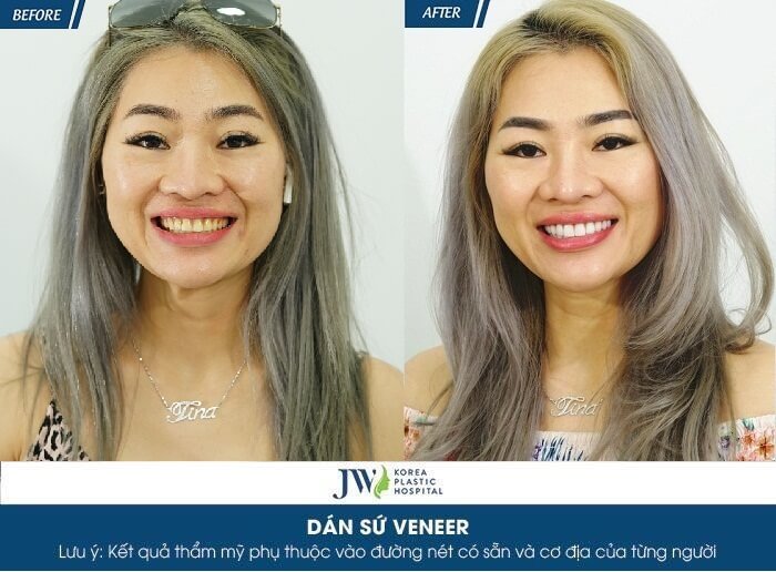 veneer_1