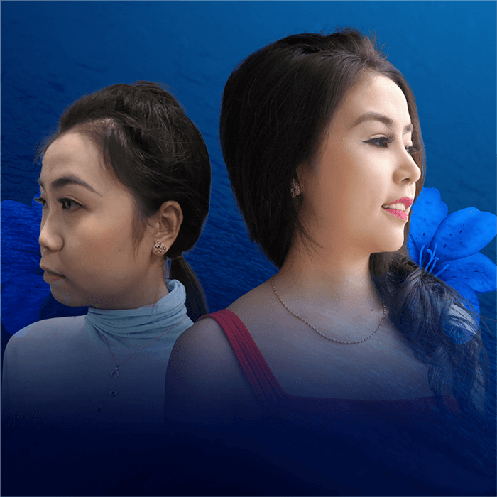 Thái Ngọc nâng mũi S Line Plus