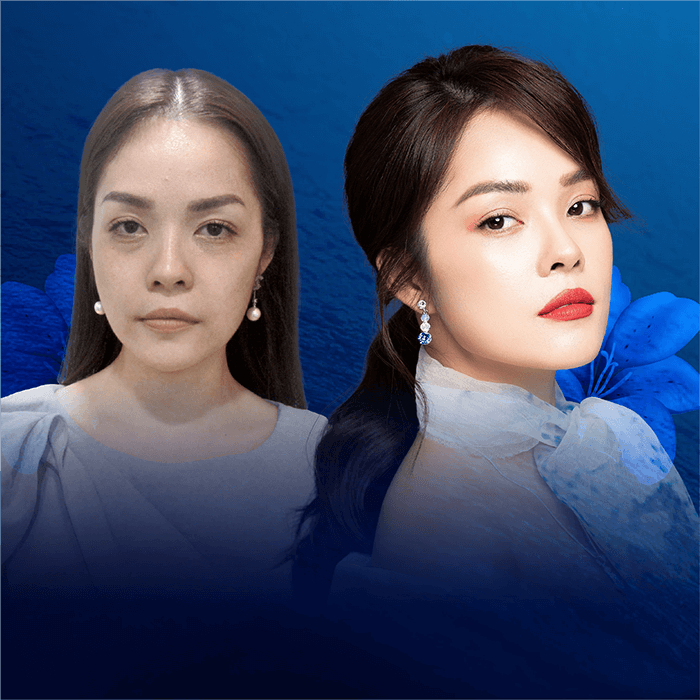Kết quả trước và sau khi diễn viên Dương Cẩm Lynh trẻ hóa da mặt tại JW Hàn Quốc