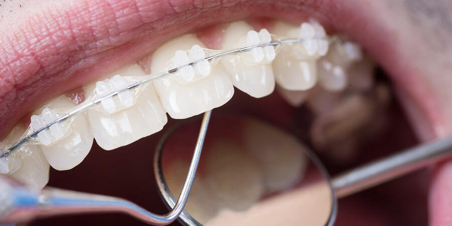 tác dụng của niềng răng