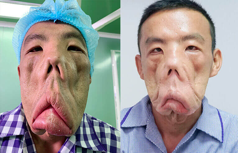 Ảnh trước sau anh Mến