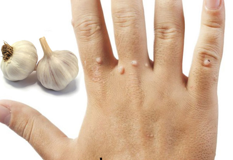 cách trị mụn thịt bằng tỏi