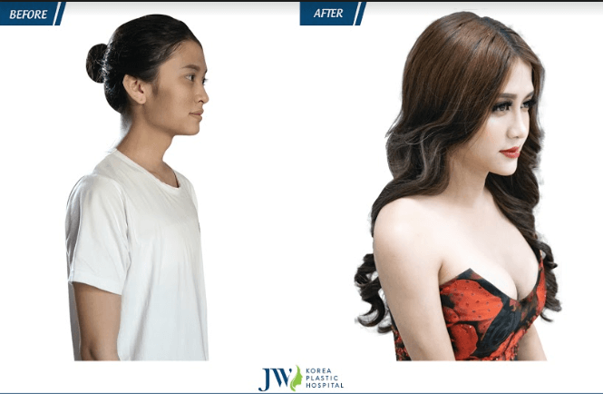 nâng ngực ở đâu tốt nhất tphcm