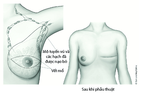 ung thư vú, tái tạo ngực