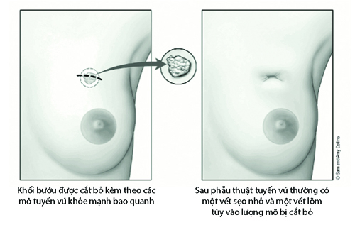 phương pháp tái tạo ngực