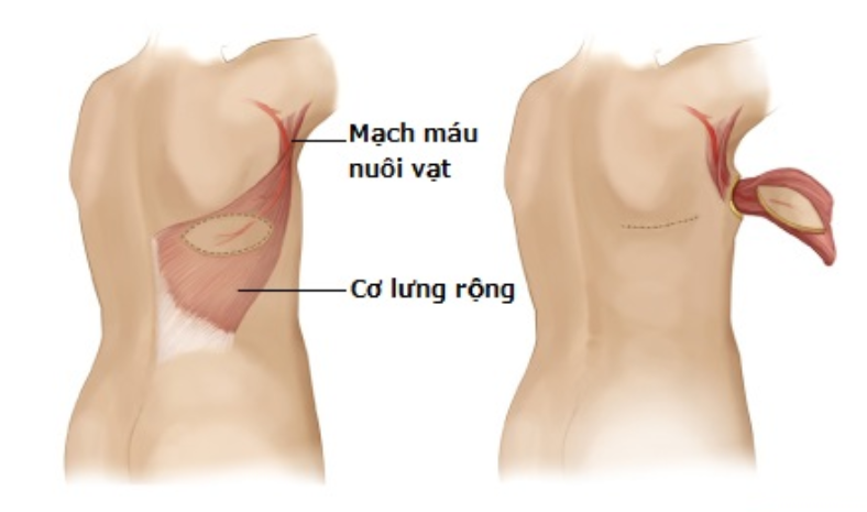 phương pháp tái tạo ngực