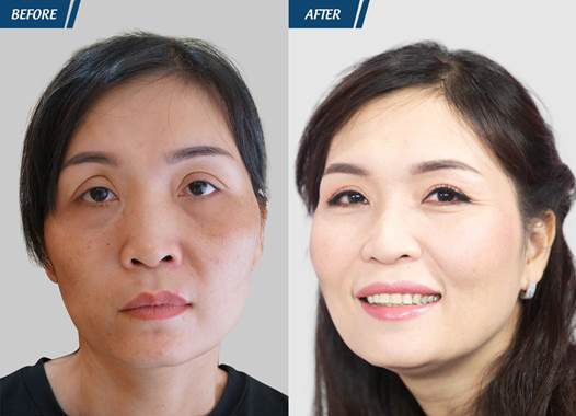 Khách hàng cắt mí tại jw