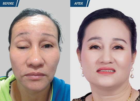 cắt mí mắt tại jw