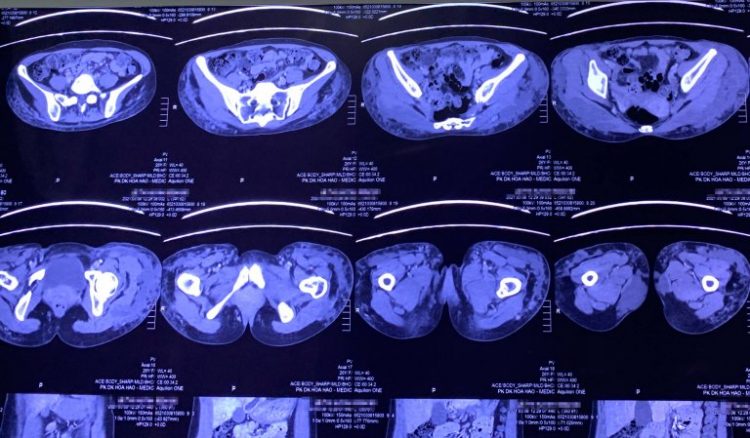 Ảnh chụp MRI vùng mông bệnh nhân