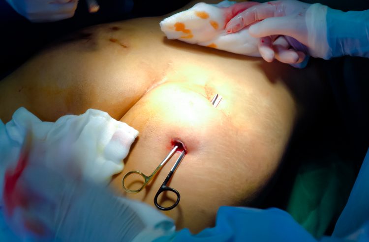 mông bị thủng vì tiêm filler ở spa