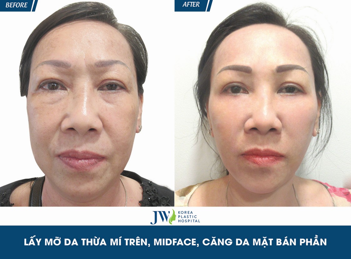 cắt mí mắt trước sau
