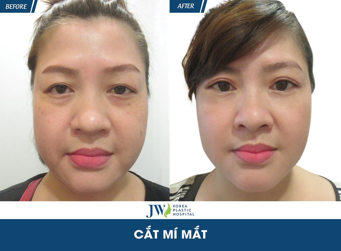 cắt mí mắt