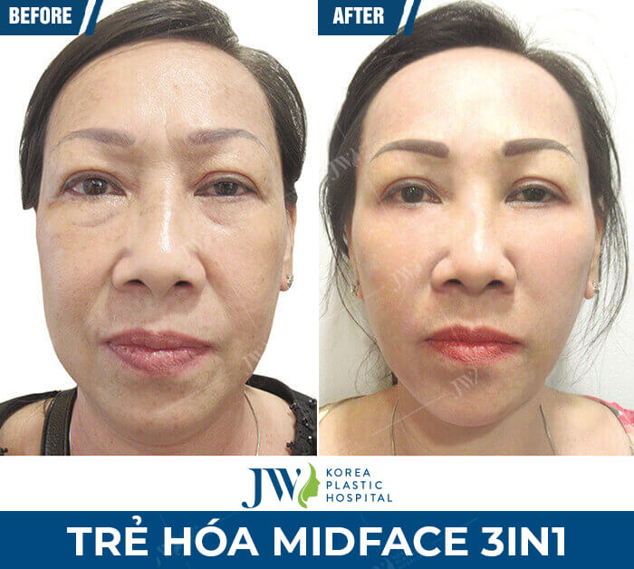 midface-3in1-jw-1