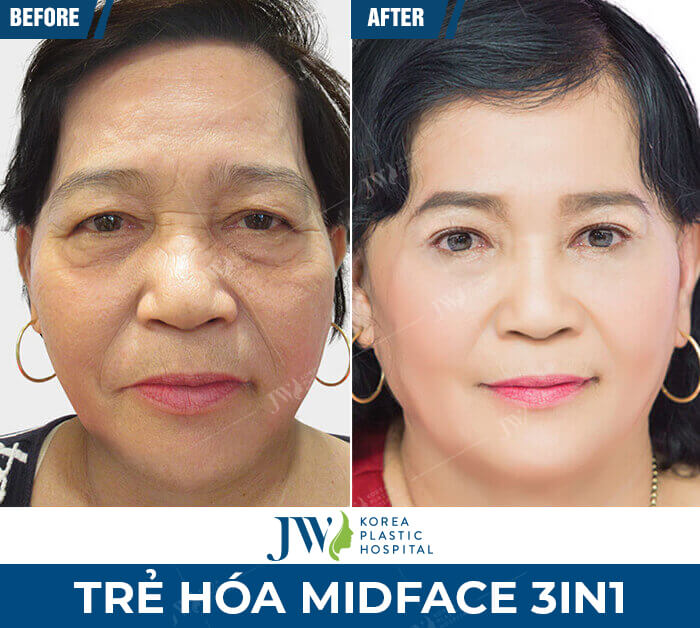midface-3in1-jw