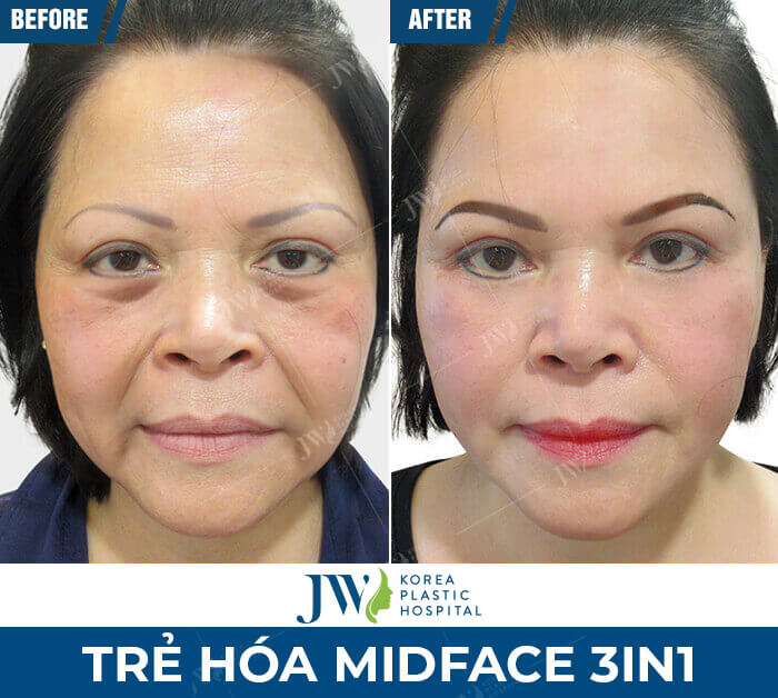 midface-3in1-jw