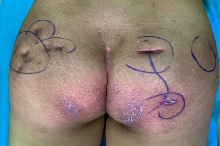 tiêm filler mông