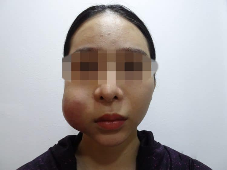 tiêm filler má bị hoại tử